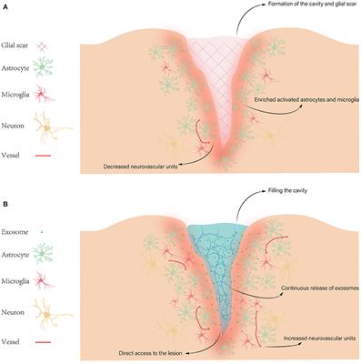 A Prosperous Application of Hydrogels With Extracellular Vesicles Release for Traumatic Brain Injury